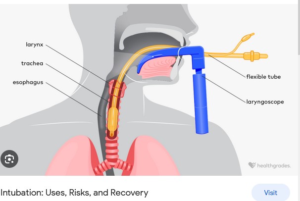 intubation-to-contain-virus